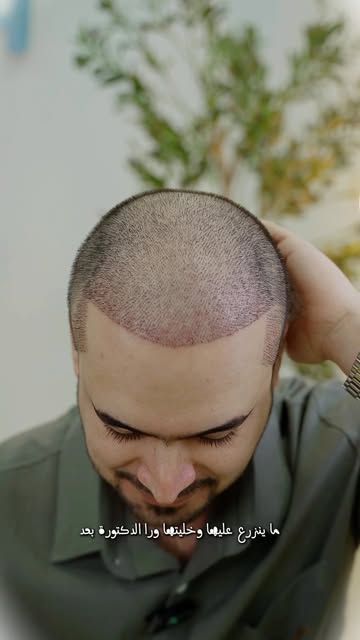 بعد 10 أيام فقط من زراعة الشعر في مركز الفاتح الدولي 
بصيلات مزروعة بكثافة وتوزيع دقيق،
جوانب متناسق