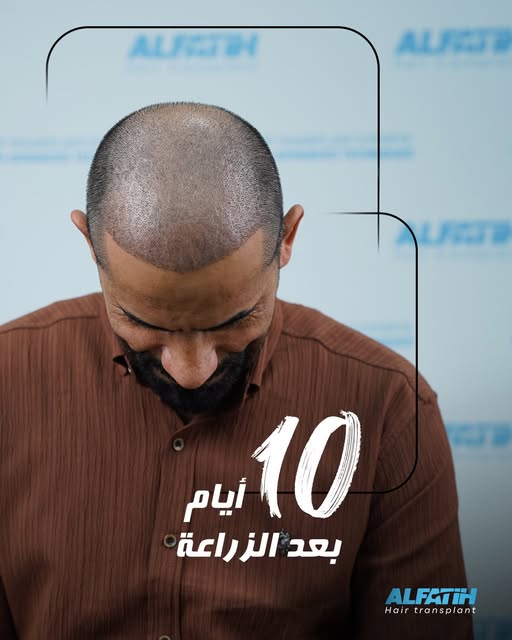 بعد عشر ايام من عملية الزراعة الشعر في مركز الفاتح الدولي  #HairTransplant