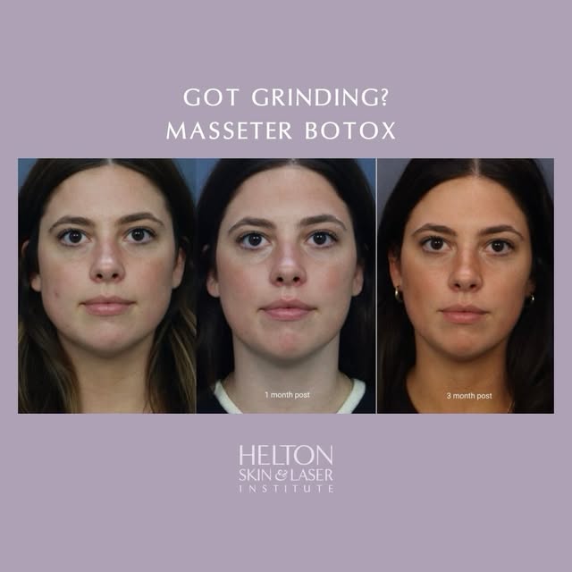 She got Botox for teeth grinding… and something unexpected happened to her face. 👀
She wasn’t tryin