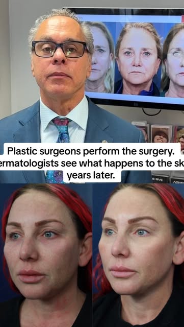 🚨 Hooded eyes? A blepharoplasty may NOT be your only option.

AGNES radiofrequency treatment allows