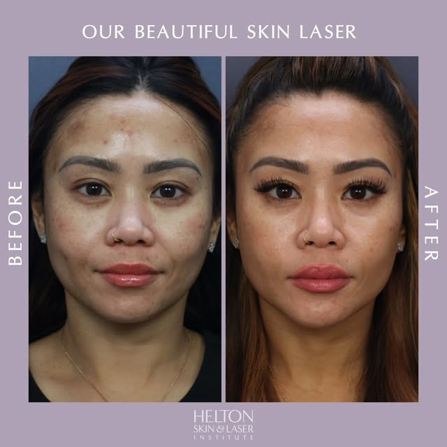 ✨ Melasma doesn’t have to control your complexion.

Melasma can be stubborn, recurrent, and difficul
