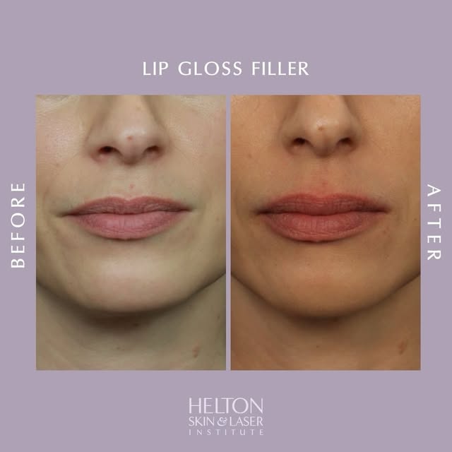 Bigger lips don’t have to look “done.” 💋

A little filler can add the perfect amount of plump while