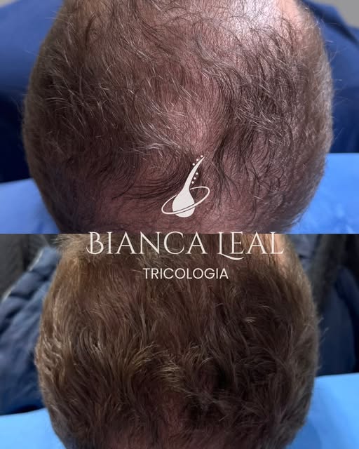 Resultado de um tratamento para alopecia androgenética 

10 sessões de aplicação em consultório + cu