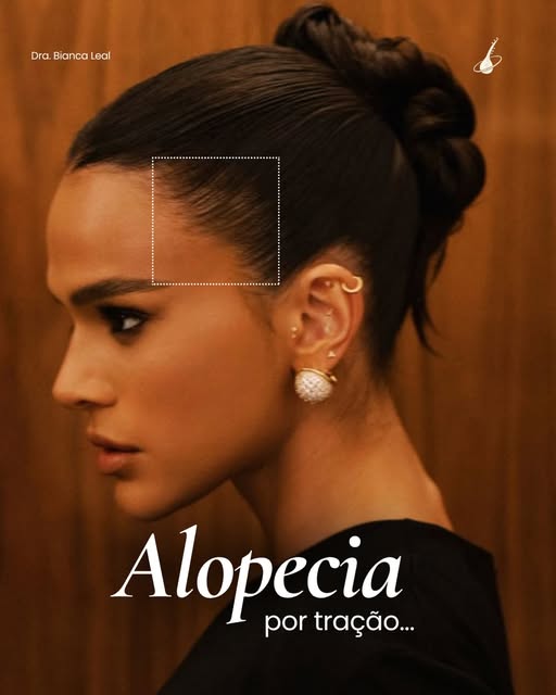 Seu penteado pode estar causando queda de cabelo — e você nem percebeu. 👀
A alopecia por tração aco