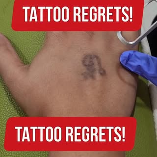 Laser doesn’t ‘erase’ tattoos.
It breaks pigment into micro-particles that your body clears over tim