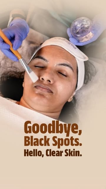 Say goodbye to uneven skin tone and dark spots with our advanced Anti-Pigmentation Treatment at IESH