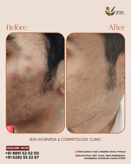 Real results speak louder than words! ✨

Acne, pimple marks, and scars കാരണം confidence നഷ്ടപ്പെട്ടു