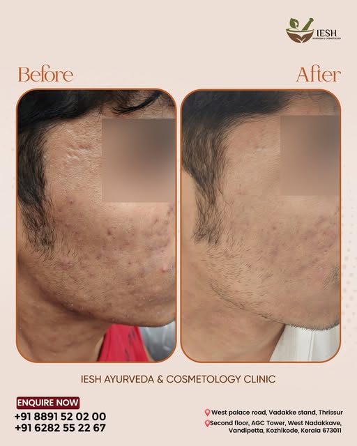 From stubborn acne scars to smooth, clear skin! ✨🌿
At IESH Ayurveda & Cosmetology Clinic, we target