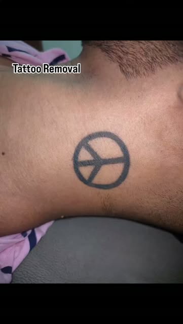 #muzaffarpur #trendingnow #tattooremoval #tattoo #post