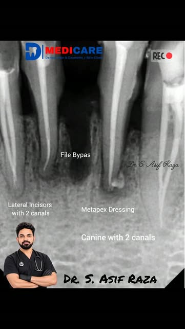 #rct #roorcanaltretment#muzaffarpur #dental_clinic #bihar