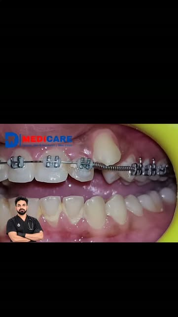 #braces #bracestreatment #ortho #highcanine #muzaffarpur