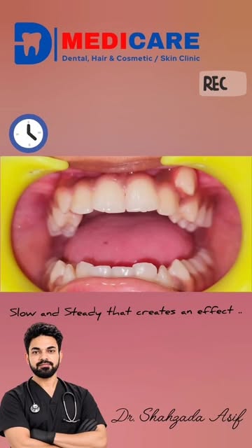 #muzaffarpur #bracestreatment #orthodontics #braces #canine
