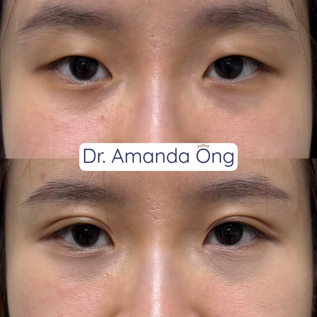 Subtle. Refined.✨ 1 month post procedure review. 

A beautifully defined upper eyelid crease created