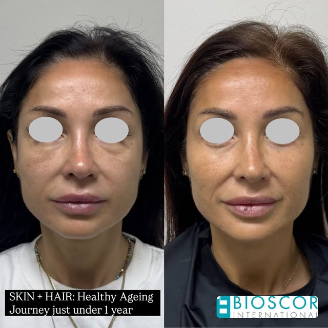 SKIN + HAIR | A Journey in Healthy Ageing ✨

At 56, this patient’s journey reflects our considered a