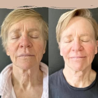 🌟 Exciting Update! 🌟 Dr. Lisa is halfway through her Exion Face treatments!

🔍 What’s the buzz ab