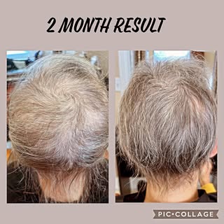 I can’t wait to share her amazing hair restoration progress!! We’ve been quietly reversing her hair 