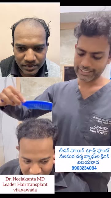 హెయిర్ ట్రాన్స్‌ప్లాంట్ చేయించుకున్నట్టు కనిపించకూడదు…
సహజంగా పుట్టిన హెయిర్‌లైన్‌లా ఉండాలి! ✨ Natur