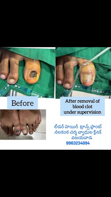 #nails #nailfungustreatment #nailclot #nailmelanoma #neelakantaskinandhairlasercentre