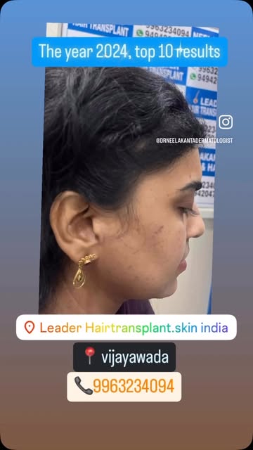 Top 10 Hairtransplant results of 2024, we will be soon with 2025 results, as most of the patients co