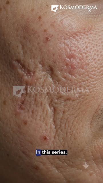 Not all acne scars are the same and treating them all the same can mean missing what your skin actua