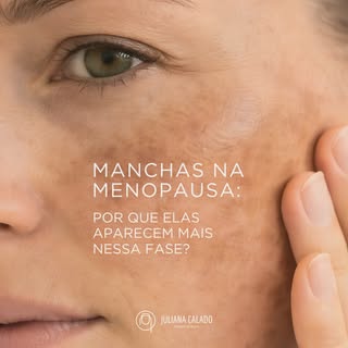 Você deve ter reparado: as manchas na pele parecem aparecer, ou escurecer, justamente depois dos 45,