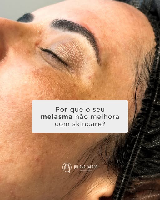 Melasma não nasce da exposição solar, nasce de um estímulo hormonal e genético que o sol, o calor e 
