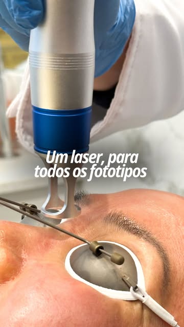 O que mais me marca nessa tecnologia é a segurança para pele negra e morena. 

Durante muito tempo, 
