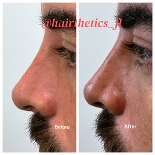 Not every nose needs surgery.

Using a high-density, highly cohesive hyaluronic acid filler, we can 