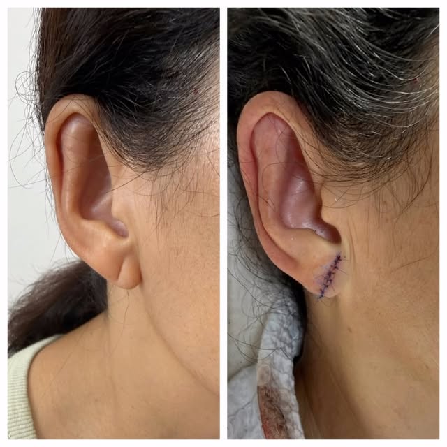 Four decades of wearing earrings left their mark—— but it doesn’t have to be permanent.✨

This patie