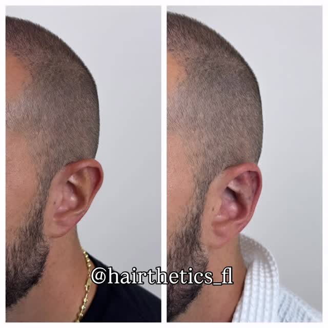 Little refinement makes a big difference in facial balancing and appearance. Contact us to explore h