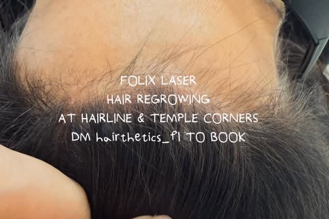 After just ONE FoLix treatment. 👀

This patient first noticed the change herself—and then both of h