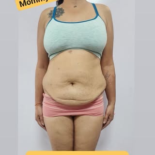 Body Shaping with Cosmet Cloud.
##Mommy Makeover
##Liposuction
##Tummy Tuck
#Body Contouring
@COSMET