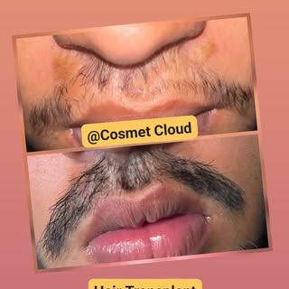 Hair Transplant 
@Cosmet Cloud.
##"Work speaks for itself"
Scar Hair Transplant.