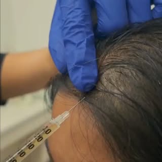 ✨ PRP Hair Restoration ✨
Support your hair’s natural growth with PRP therapy. A personalized treatme