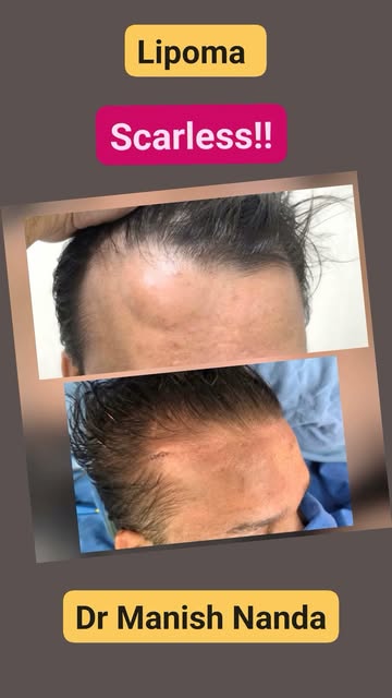 Scarless Lipoma surgery with 
Dr Manish Nanda@Cosmet Cloud.