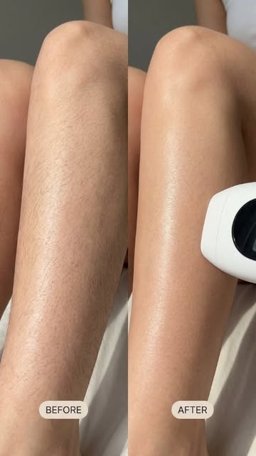 Smooth skin starts with the right laser care ✨
Say goodbye to unwanted hair and hello to smoother, m