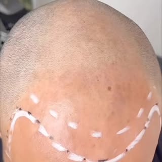 Faded Hailine genannt schwer um zu setzten. Das Ergebnis ist das die Haarlinie soft nach unten verlä