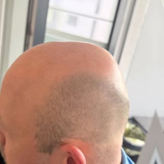 #haarpigmentierung #haarpigmentierungaachen #beautytech #neuesich #smp #fragenundantworten 

Heute e