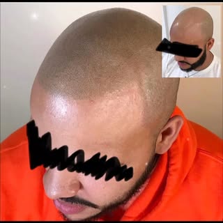 Kunde mit einem typischen kreisrunden Haarausfall. Nach 3 Sessions behoben 🙂 #haarpigmentierung #ha