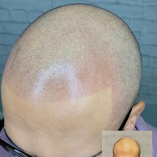 Top Ergebnis nach 4 Sessions Kunde wollte gerne eine gerade Hairline. Gesagt getan 🙂