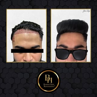 A fresh lineup, for life.
This patient had thick, dark hair with high native density and wanted a sh