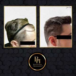 This patient with medium-textured blonde hair wanted a natural, undetectable hairline. We matched hi