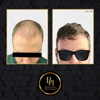 Natural results, renewed confidence.
This patient with medium-textured, slightly wavy hair wanted a 