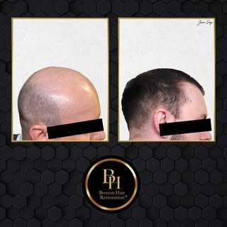 A case of strategic restoration.

This patient had medium-texture, straight hair and underwent an ex