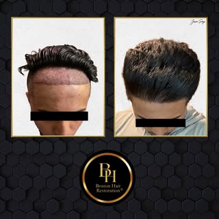 This patient wanted a lower, sharper hairline to enhance his facial symmetry, requesting a defined, 