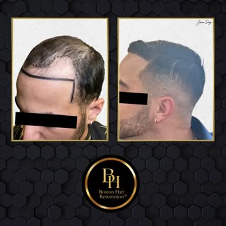 This patient came to us with extensive recession and medium hair texture, plus a natural curve in hi