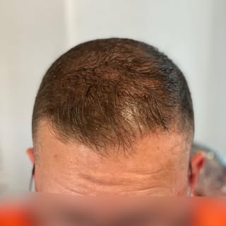 Transformations. One impression at a time. 🖊️🖊️🖊️

🚨5 FREE Consultation slots remaining for Augu