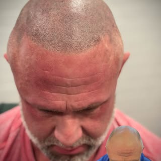 💪 Bald is bold. But sometimes, even the bold want a little boost.

Scalp Micropigmentation (SMP) is