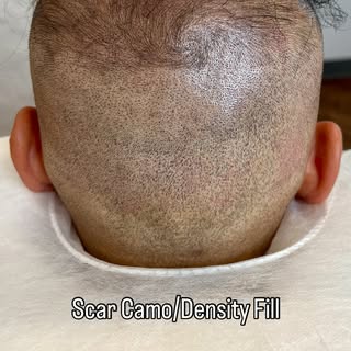 Tired of hiding scars and thinning spots? 👀
Hair transplants don’t always bring back full density —
