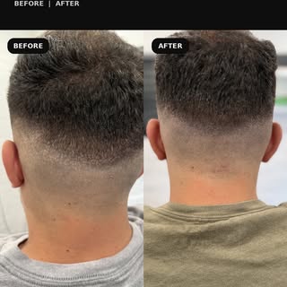 Hair transplant scars don’t have to dictate how short you wear your hair.

FUE transplants can leave